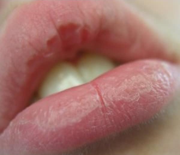 swollen chapped lips