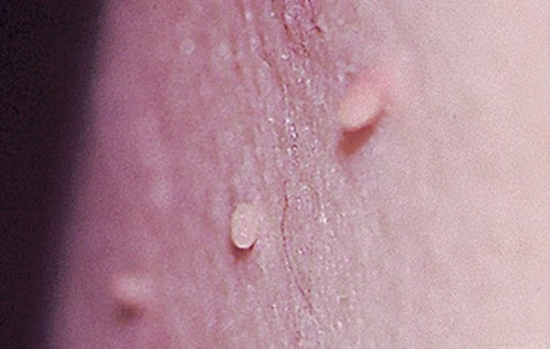 Genital Warts Pictures and photos - STD Information