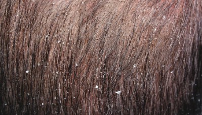 Get rid of dandruff.