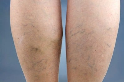 Shrink varicose veins.