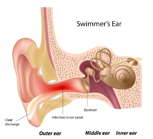 Prevent swimmer's ear.